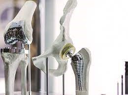 Orthopedic Implants